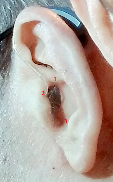 Cropped%20Ear%20Mold%20Closeup